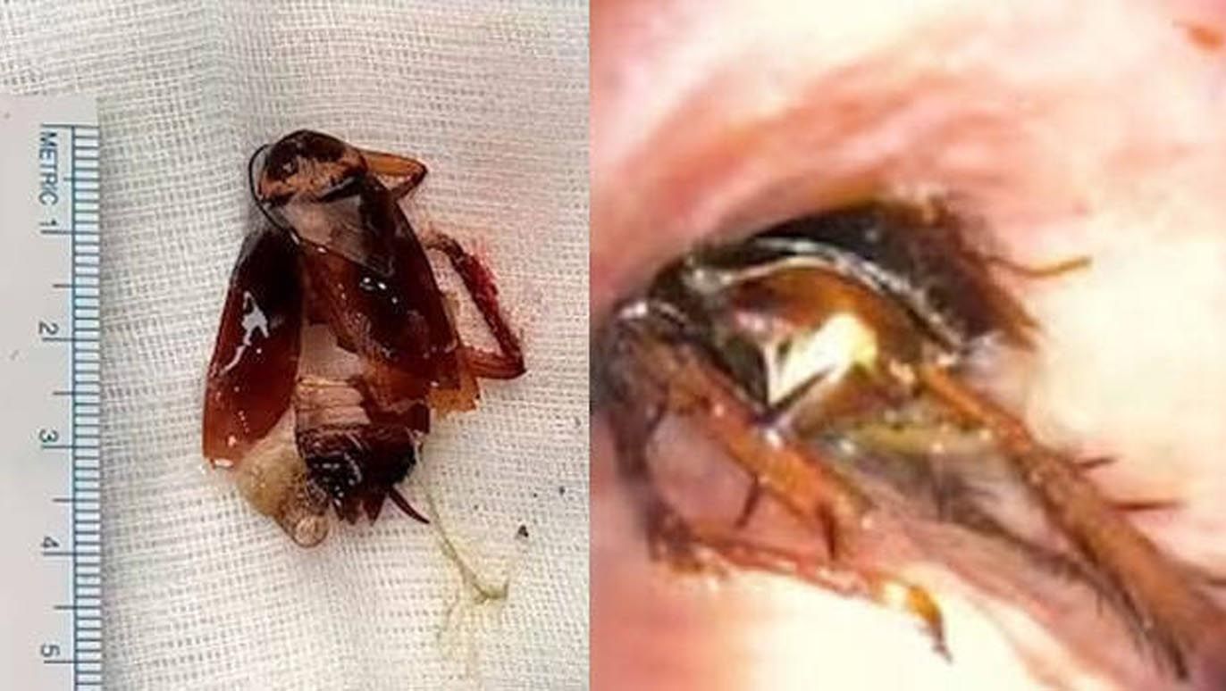 A-cockroach-from-the-lungs