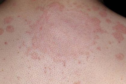 Tiniya disease