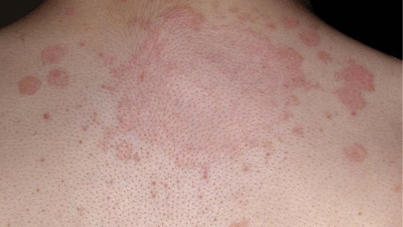Tiniya disease